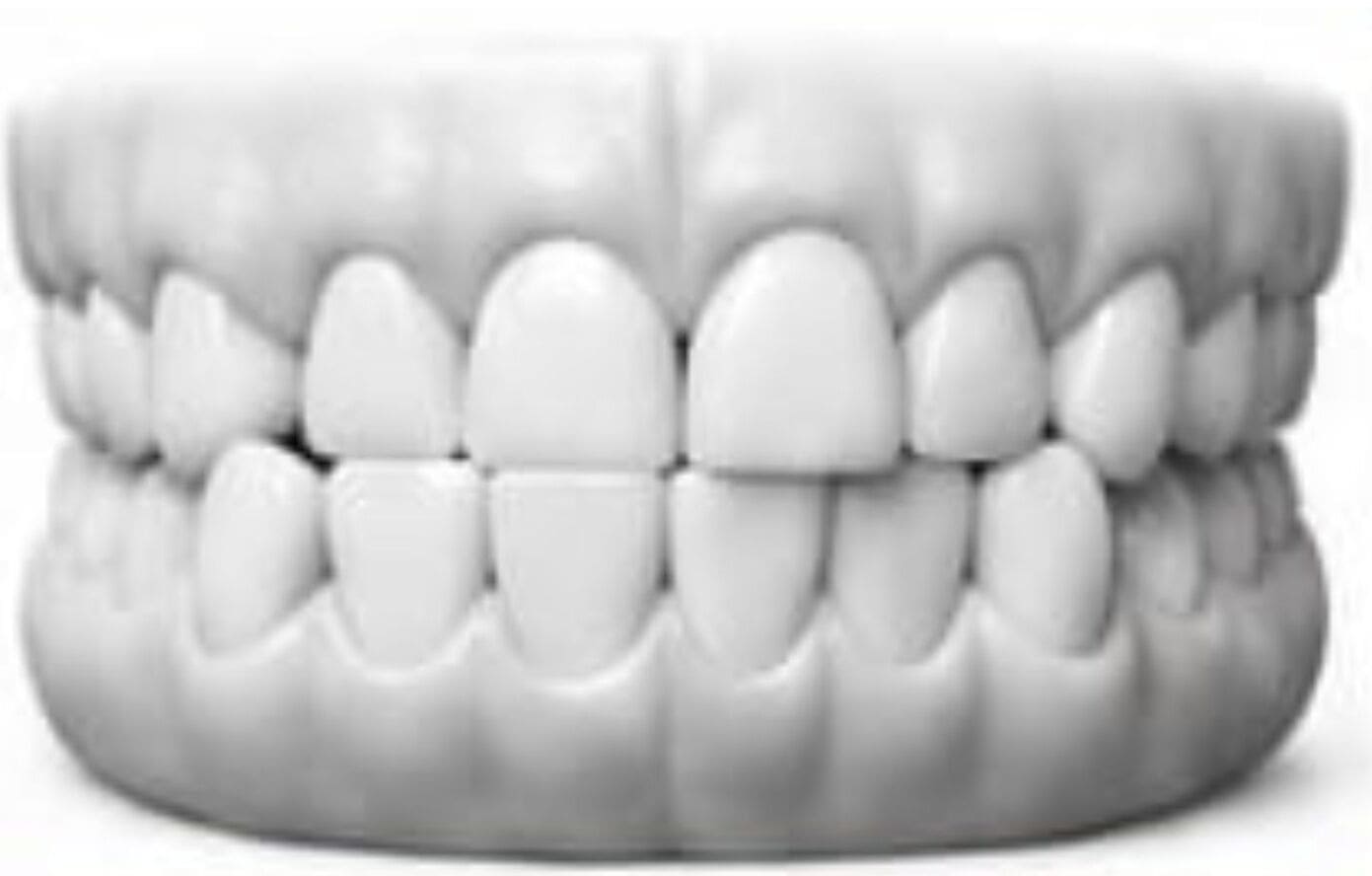 Crossbite