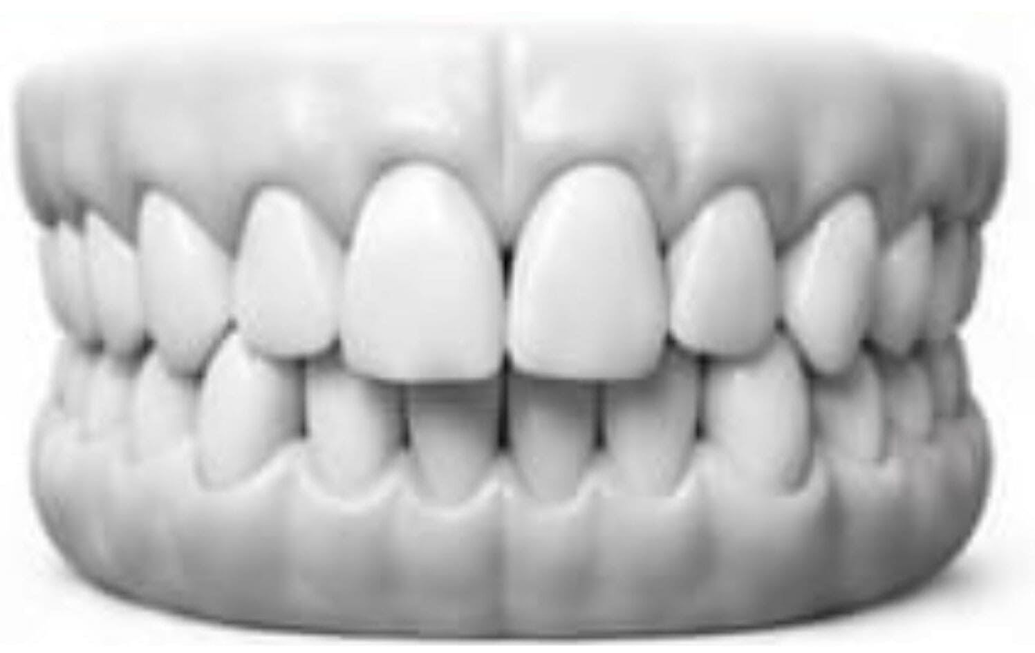 Crowded Teeth