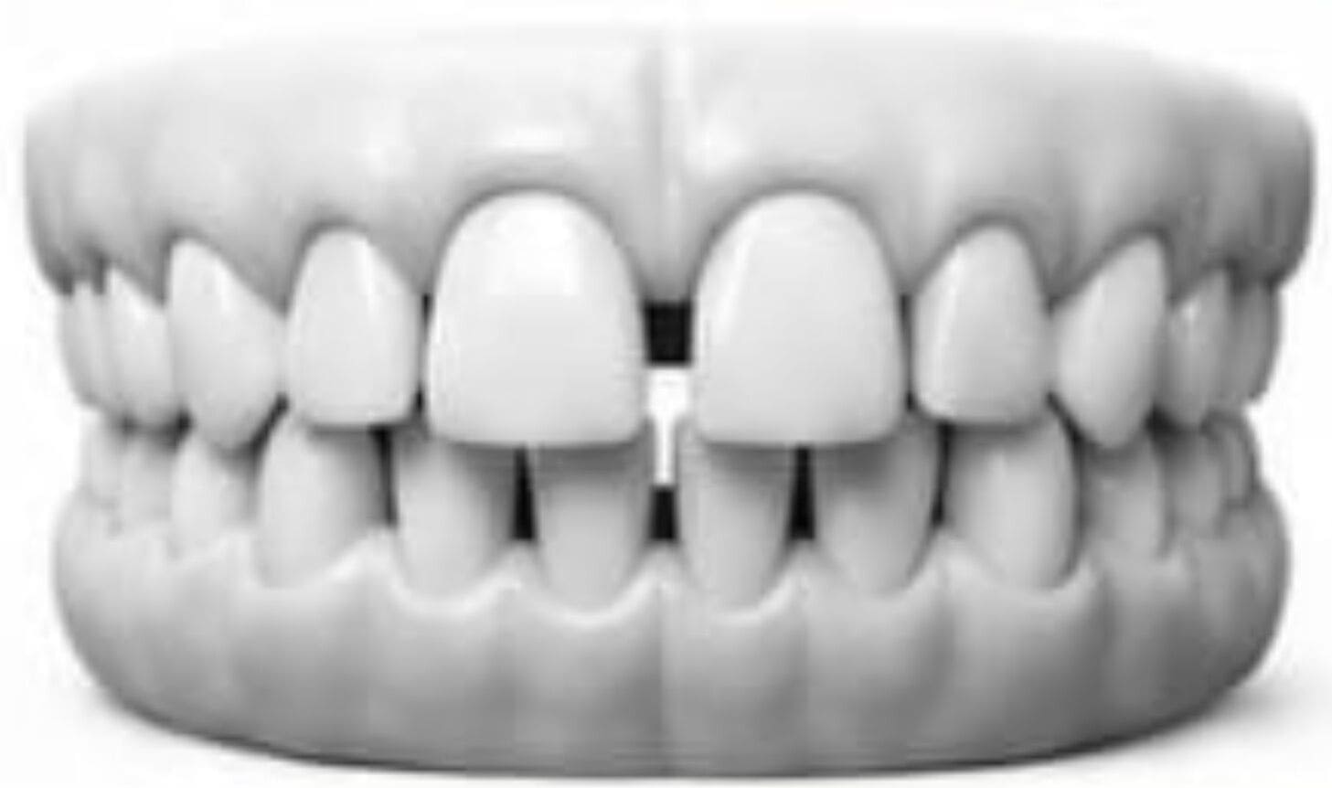 Gapped Teeth