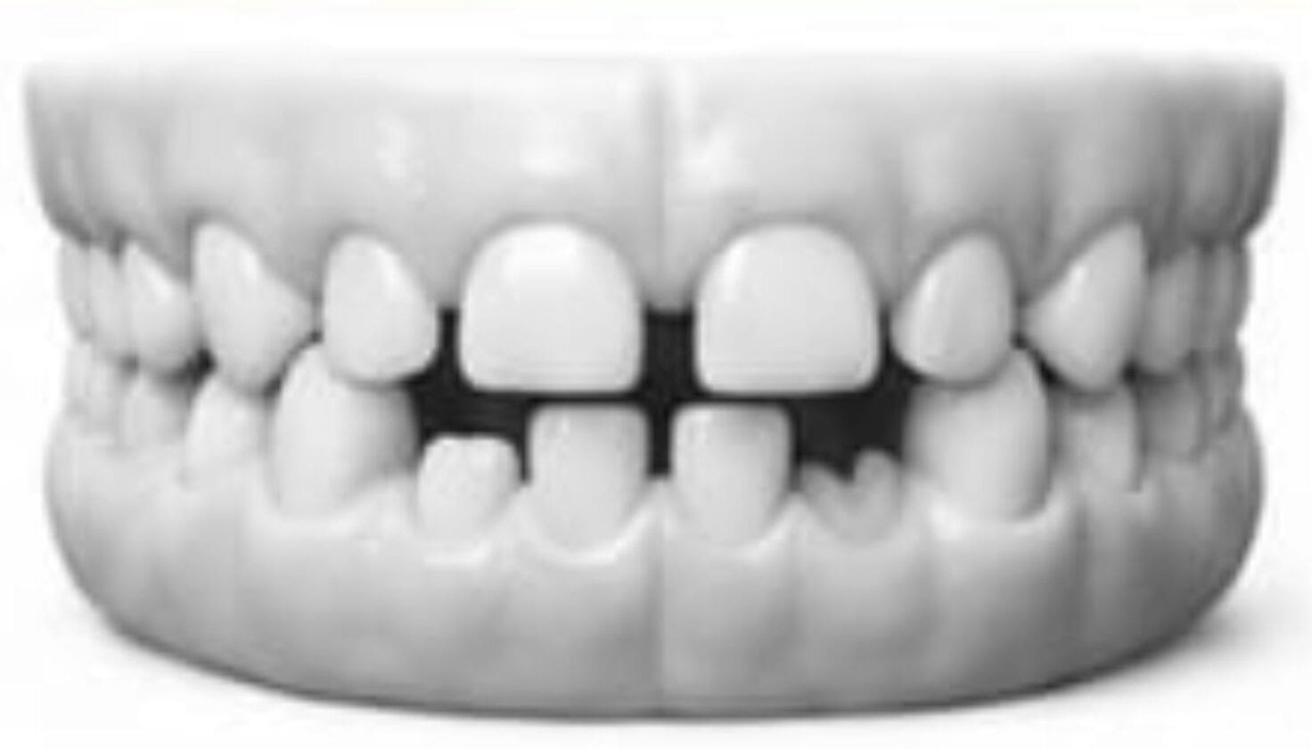Mixed / Erupting Teeth