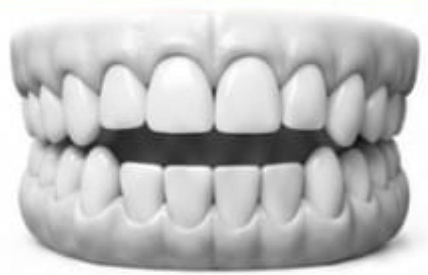 Open Bite