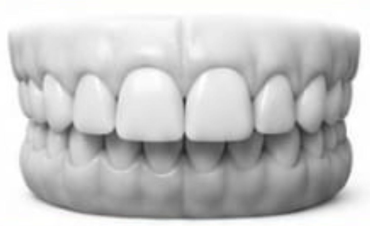 Overbite
