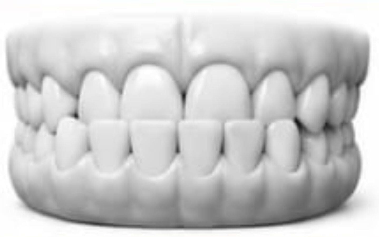 Underbite